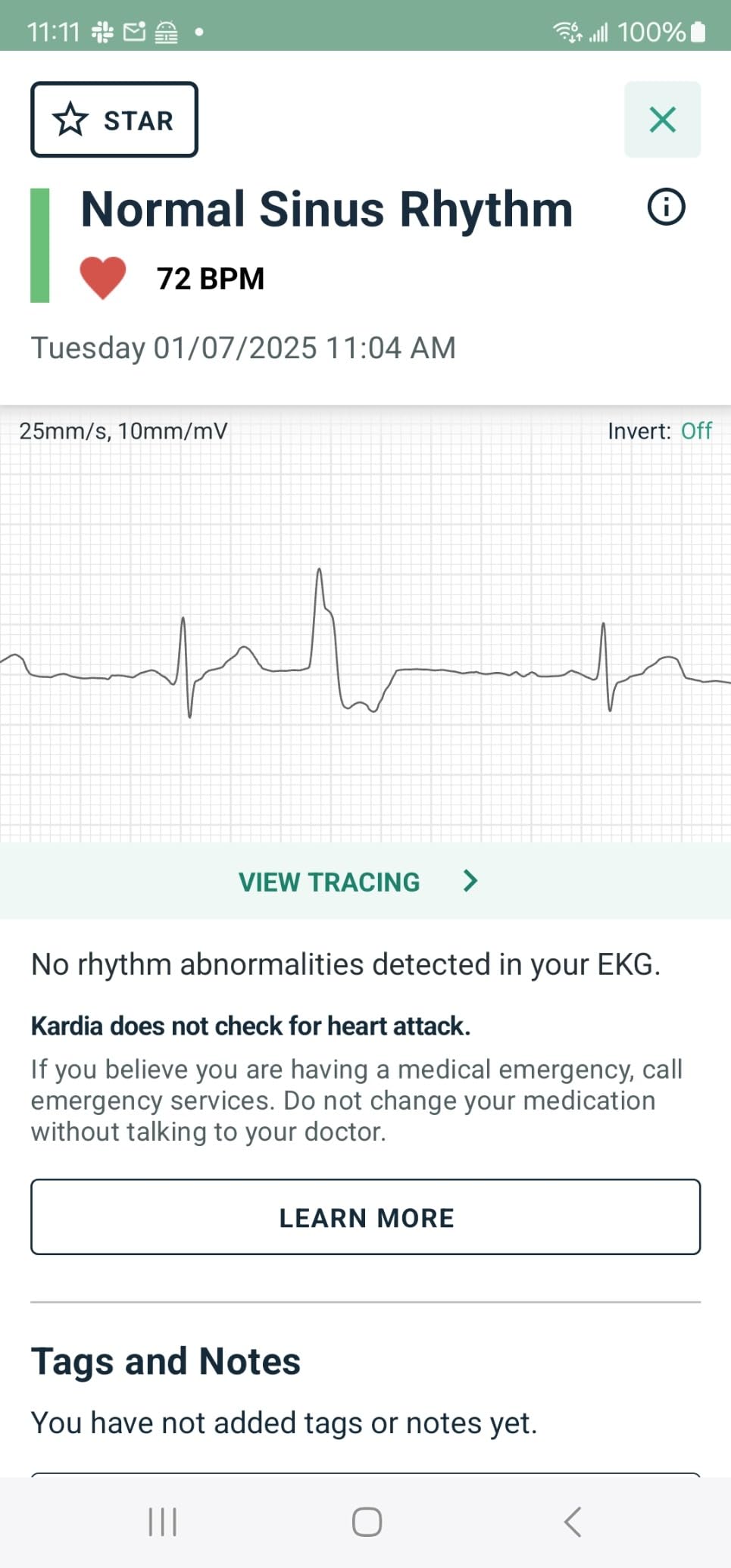 KardiaMobile 6L EKG, No Membership Required, Unlimited Recordings, HSA/FSA | Detects 4 Arrhythmias, FDA-Cleared Heart Monitor, Medical-Grade Results in 30 Seconds, Works with Smartphones and Tablets customer photo 1